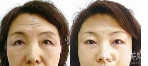祛抬頭紋多少錢 去抬頭紋的方法