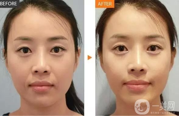 熱瑪吉除皺*果 熱瑪吉祛皺*嗎