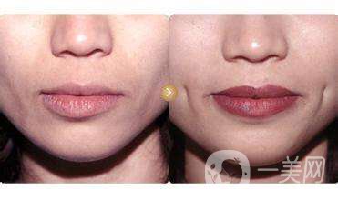 班加羅爾酒窩創(chuàng)造手術(shù)*果怎么樣