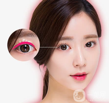 亞韓割雙眼皮多少錢？