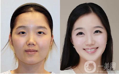 班加羅爾面部頸部抽脂術(shù)怎么樣 價(jià)格是多少？