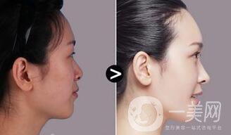 隆鼻多少錢,隆鼻術(shù)后注意事項