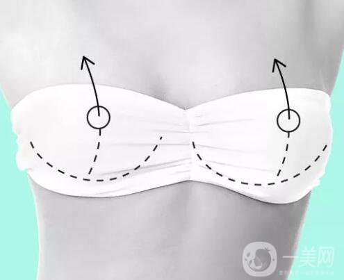 隆胸多少錢(qián)？術(shù)后有哪些注意事項(xiàng)？