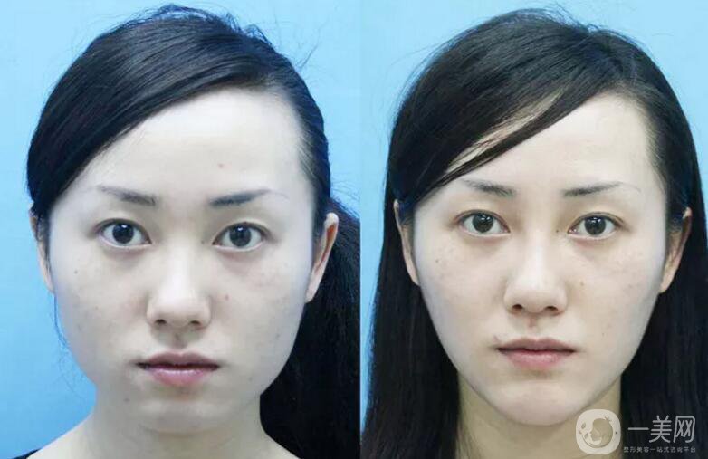 下頜角磨骨整形價格貴嗎？需要多少錢？