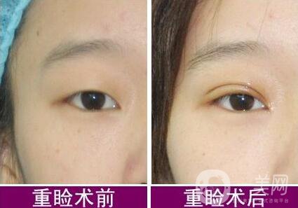 5s重瞼術(shù)和全切的區(qū)別 5s重瞼術(shù)是*的嗎