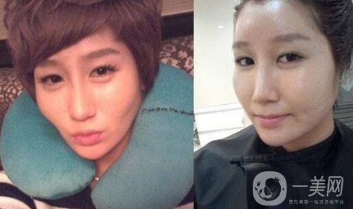 面部脂肪填充*果*嗎 注意事項有哪些