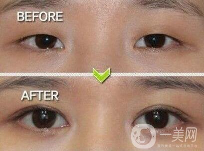 韓式割雙眼皮,韓式割雙眼皮多少錢,上海割雙眼皮價格