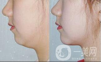 深圳雙下巴吸脂價(jià)格,雙下巴吸脂多久恢復(fù)