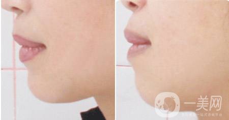 面部光纖溶脂會反彈嗎 有副作用嗎