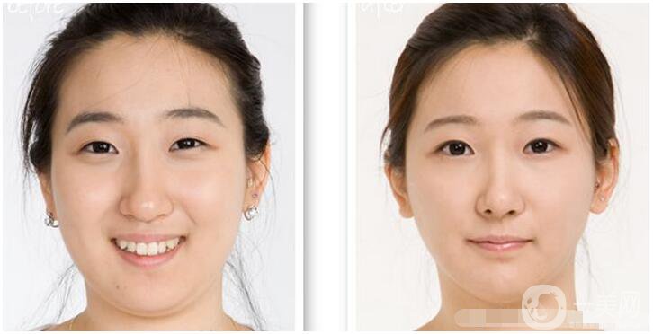 什么是雙下巴手術(shù)？術(shù)前需要準(zhǔn)備什么？