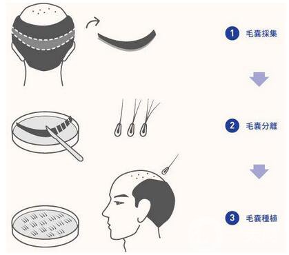FUE毛發(fā)移植技術好嗎?