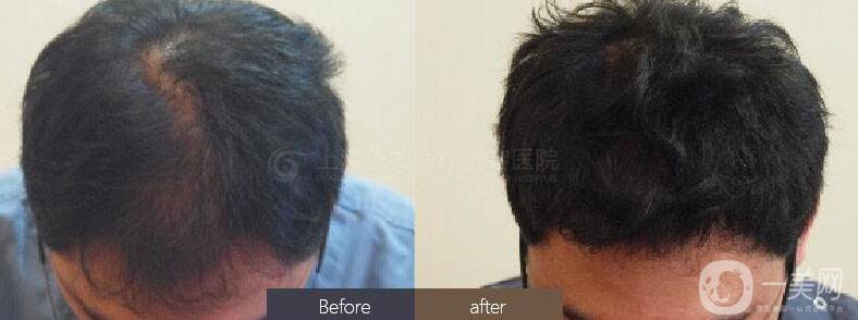 FUE毛發(fā)移植風險