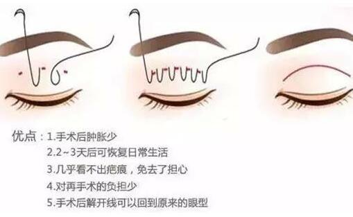 做埋線雙眼皮術(shù)后多久恢復(fù) 注意事項(xiàng)是什么
