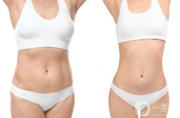 為什么抽脂如此*?抽脂有什么風(fēng)險(xiǎn)?