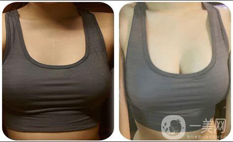 隆胸手術(shù)后應(yīng)該注意什么？如何護(hù)理？