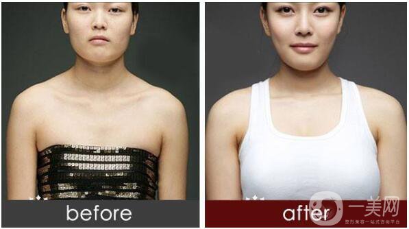 假體隆胸材料圓形和水滴形有什么區(qū)別？