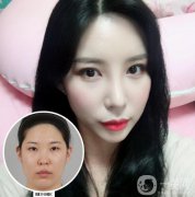 鼻部手術(shù)+雙眼皮手術(shù)術(shù)后恢復(fù)日記