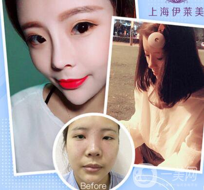 上海伊萊美口碑怎么樣？是正規(guī)醫(yī)院嗎？