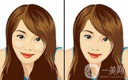 磨顴骨優(yōu)缺點(diǎn)有哪些 磨顴骨的*果自然嗎