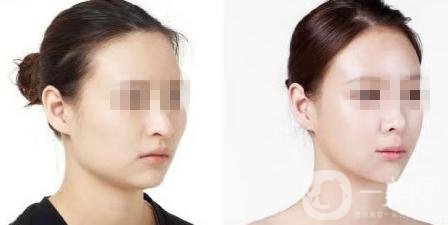 磨顴骨優(yōu)缺點(diǎn)有哪些 磨顴骨的*果自然嗎