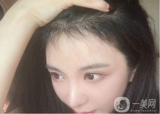 做*植發(fā)要多少錢 做*植發(fā)好不好