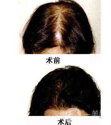 做*植發(fā)要多少錢 做*植發(fā)好不好