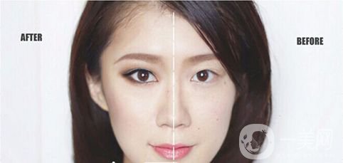 重慶做雙眼皮要多少錢(qián) 割雙眼皮喲風(fēng)險(xiǎn)嗎