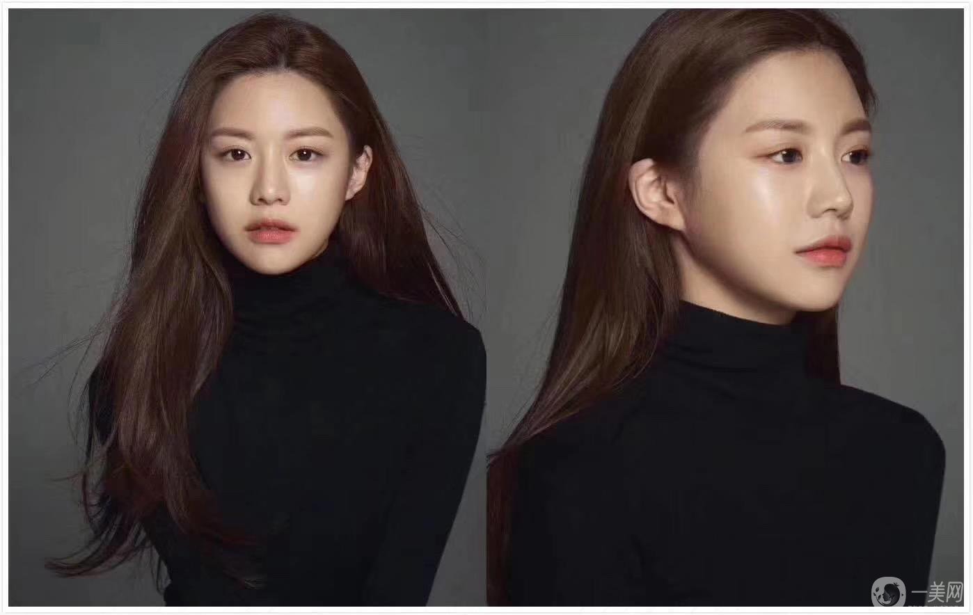 重慶做雙眼皮要多少錢(qián) 割雙眼皮喲風(fēng)險(xiǎn)嗎