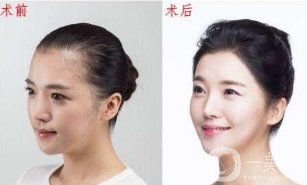 班加羅爾的毛發(fā)移植怎么樣,價(jià)格,*果好不好