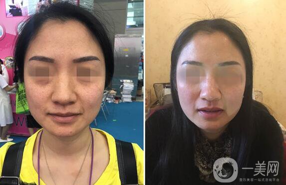 到底哪種面部提升手術(shù)適合你？