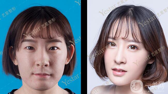 *前后 *手術(shù)*果如何？