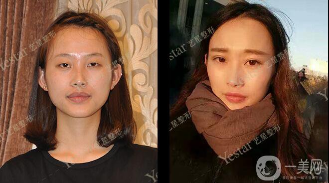 *前后 *手術(shù)*果如何？