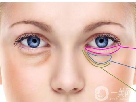 深圳去眼袋手術多少錢 去眼袋有什么風險嗎？