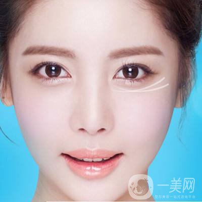 深圳去眼袋手術多少錢 去眼袋有什么風險嗎？