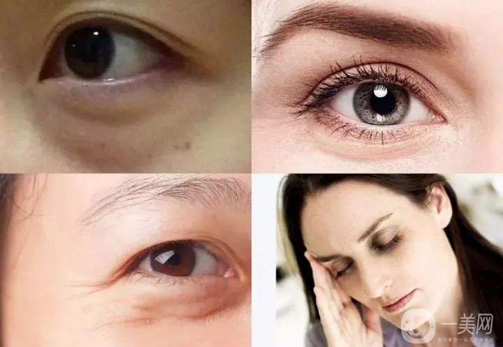 深圳去眼袋手術多少錢 去眼袋有什么風險嗎？