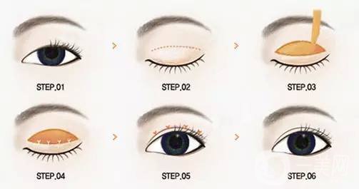 割雙眼皮多久后熱敷 割雙眼皮多久可以化妝