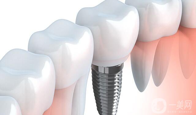 深圳種植牙價(jià)格,深圳種植牙多少錢