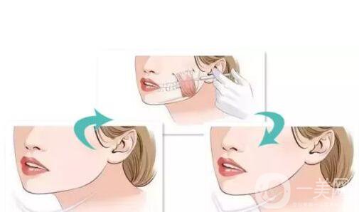 *一針要多少錢 *的藥*是*的嗎