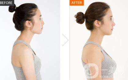 假體隆胸的價(jià)格是多少 假體隆胸能保持多久