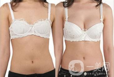沃斯堡豐胸術(shù)怎么樣 隆胸的風(fēng)險(xiǎn)有多大？