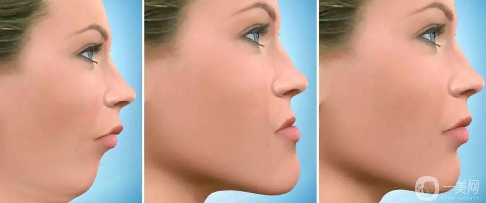 兒童天包地牙齒矯正