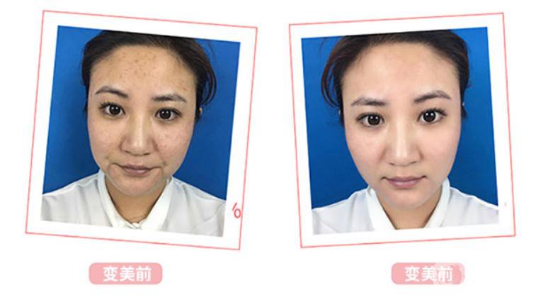 光子嫩膚*果介紹？對(duì)皮膚會(huì)有傷害嗎？