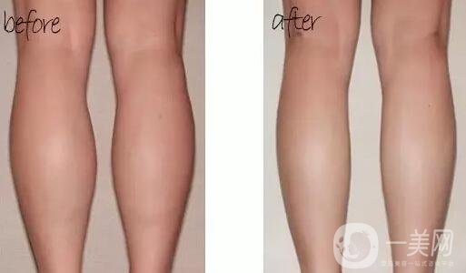 **多少錢 有副作用嗎 需要注射幾次？