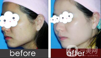 激光光子嫩膚價格,光子嫩膚*果