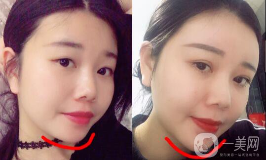 自體脂肪墊下巴恢復(fù)期是怎樣的？如何做好術(shù)后護(hù)理？