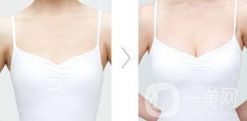 假體隆胸,假體隆胸術(shù)后注意事項