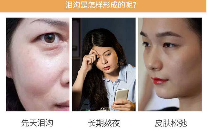 膠原蛋白填淚溝恢復(fù)期是多久呢 術(shù)后護理要注意什么？