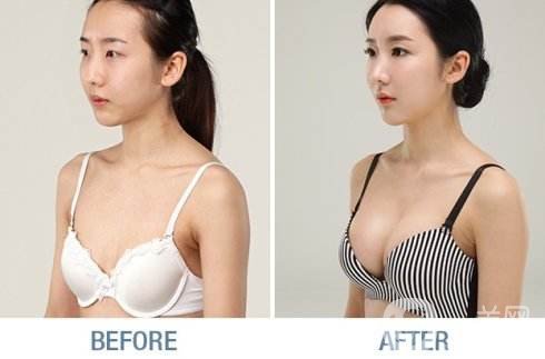 脂肪填充隆胸貴嗎 隆胸手術(shù)費用 手術(shù)方式有哪些