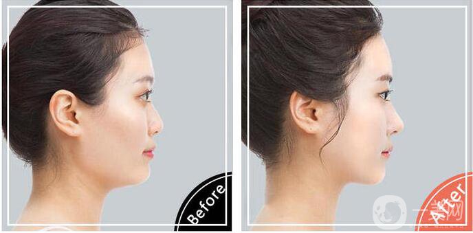 鼻頭縮小手術圖,鼻頭縮小術后護理