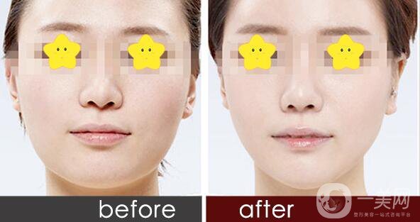 *瘦臉貴嗎,*瘦臉多少錢(qián)